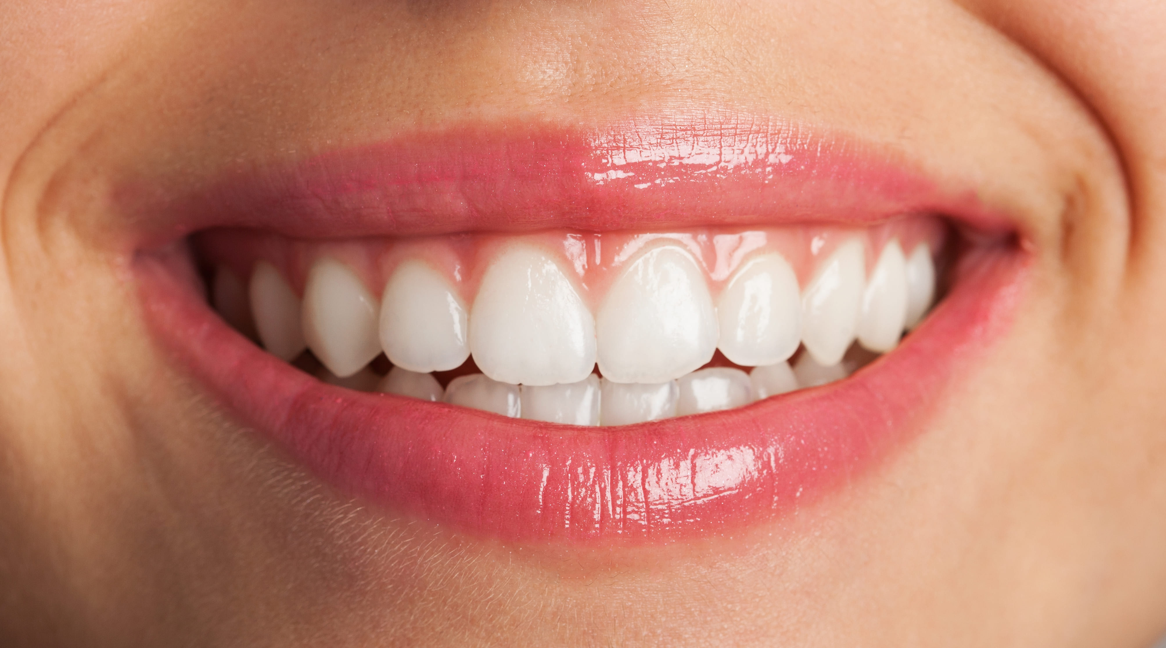 Transformación de la Sonrisa a través de las Carillas Dentales